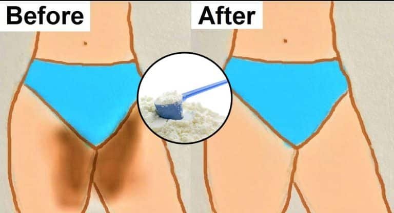 Beauty Tips : ప్రైవేట్ పార్ట్స్ దగ్గర చర్మం నల్లగా అయిపోతుందని బాధపడుతున్నారా… అయితే ఒక్కసారి ఈ చిట్కాను ట్రై చేయండి….!