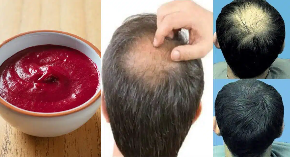 Hair Tips on Beetroot Hair Pack