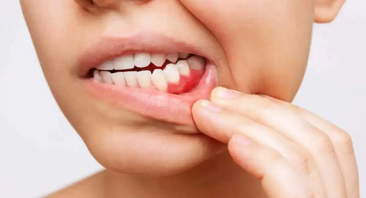 Health Tips on bleeding gums causes and treatment home remedies to cure teeth
