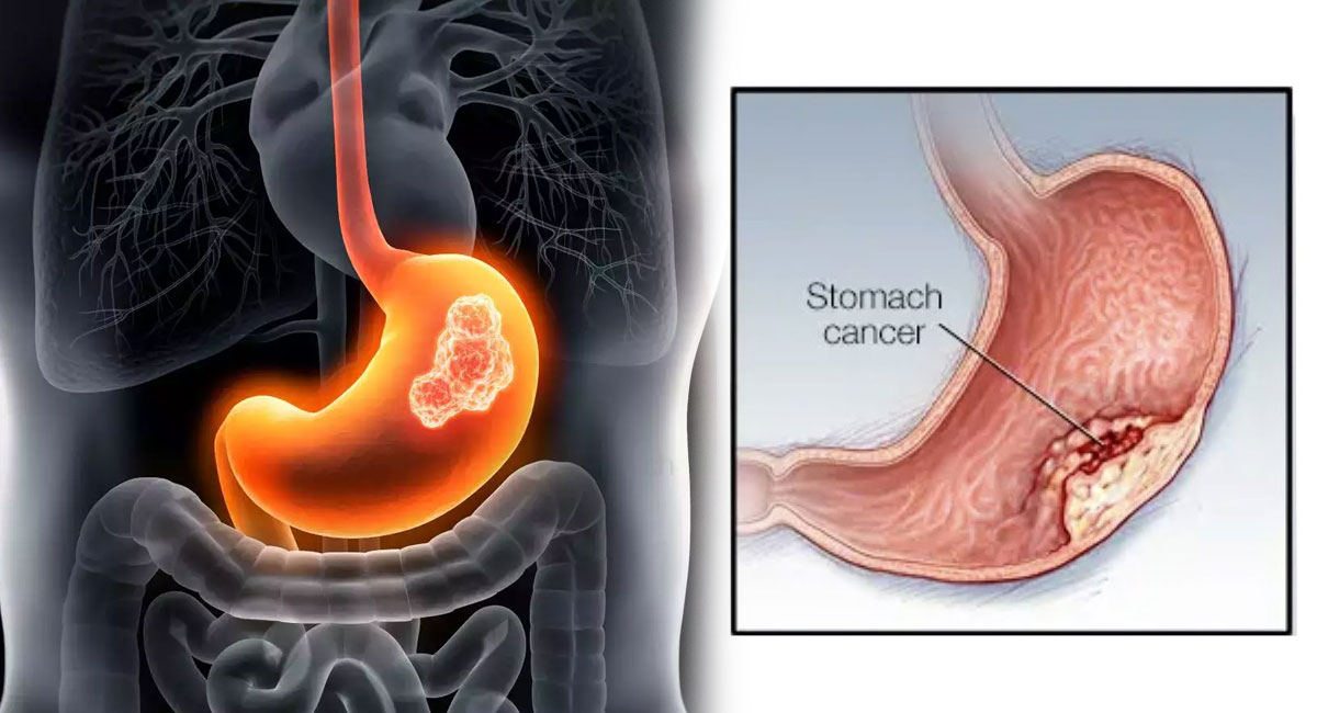 Stomach Cancer : ముఖముపై ఈ లక్షణాలు కనిపిస్తే కడుపు క్యాన్సర్ ఉన్నట్లే…!