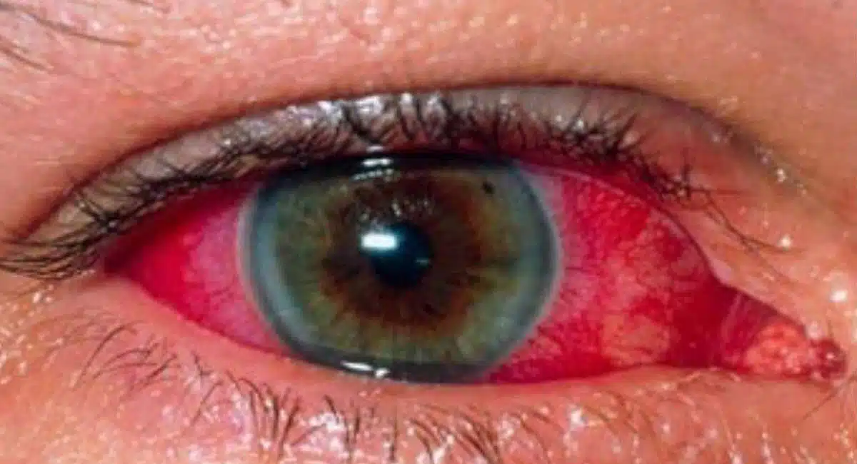 Health Tips Your eyes are red