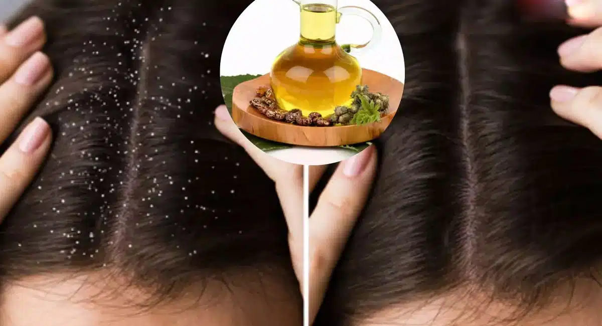 Are you suffering from dandruff problem in winter