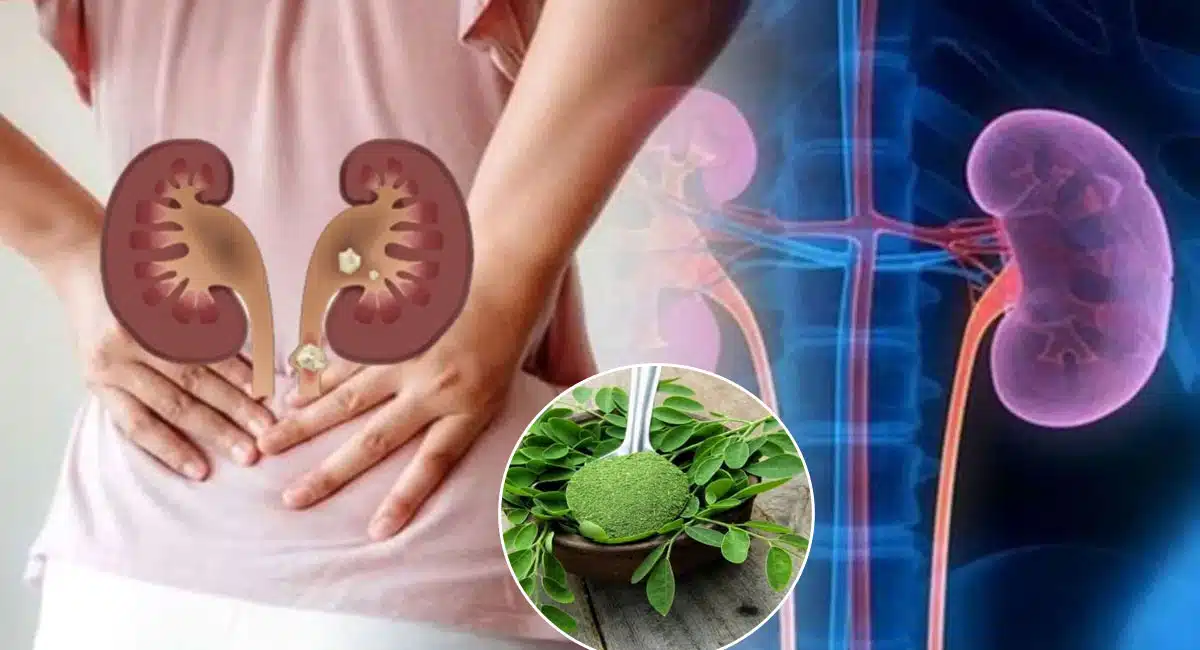 Are you suffering from Kidney Stone Problem