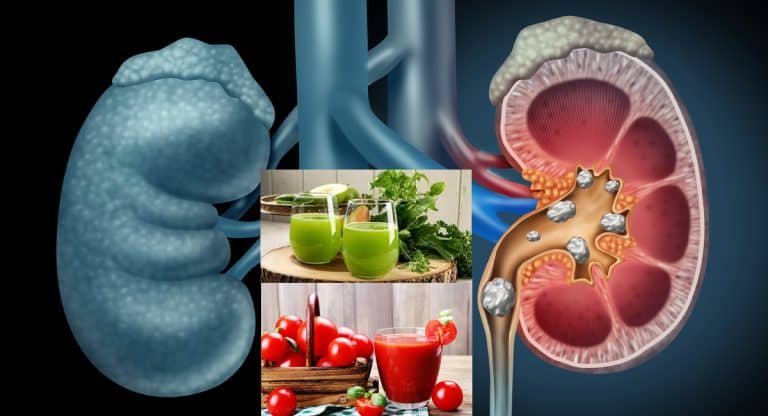Kidney Stones : కిడ్నీ స్టోన్స్ తో ఇబ్బంది పడుతున్నారా..? ఈ మూడు జ్యూసులతో వాటికి చెక్ పెట్టవచ్చు…