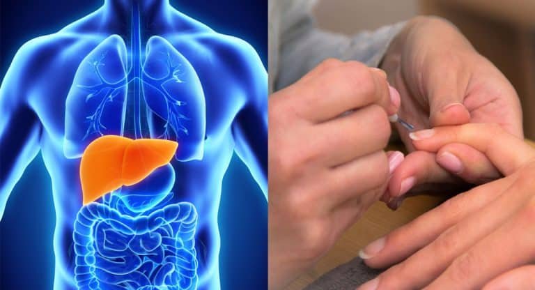 Liver Disease : మీ గోళ్లు ఈ రంగులో కనిపిస్తున్నాయా.. అయితే లివర్ వ్యాధి సోకినట్లే…!!