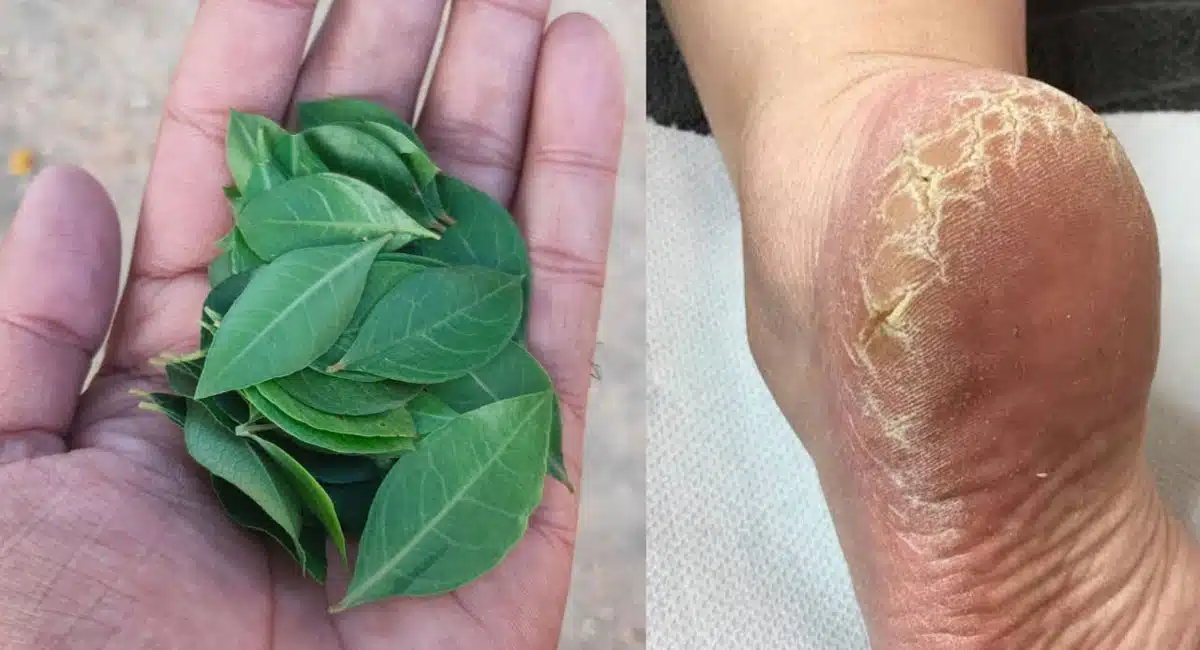 Simple Home Remedies For Cracked Heels