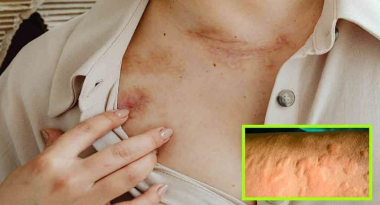 Skin Allergy Tips : ఈ పదార్థాలతో దురద, దద్దుర్లు సమస్యలకు పెట్టవచ్చు…!!