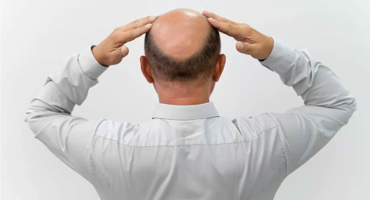 Baldness : బట్టతలతో లక్షలు సంపాదించిన ఓ వ్యక్తి .. ఏకంగా 71 లక్షలు సొంతం చేసుకున్నాడు ఇలా !!