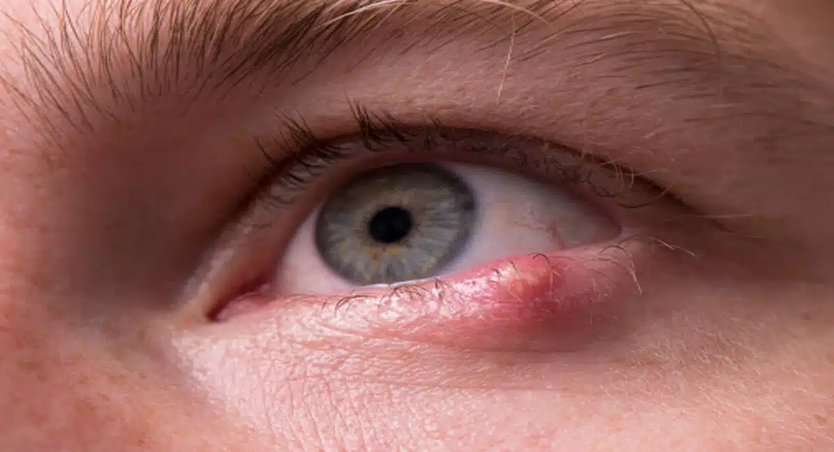Are you suffering from Eye Lump inflammation