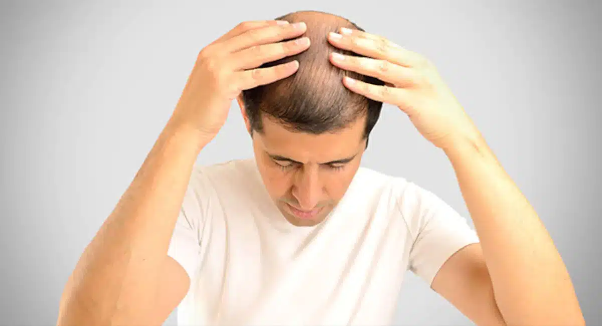 Hair Tips like saying welcome to baldness at an early age