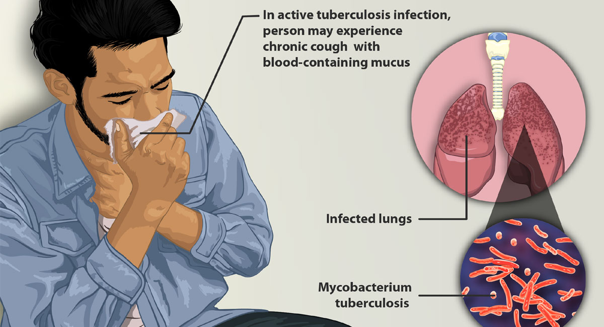 Tuberculosis : టిబి ఇటువంటి వారికే ఎక్కువగా వస్తుందట…!!