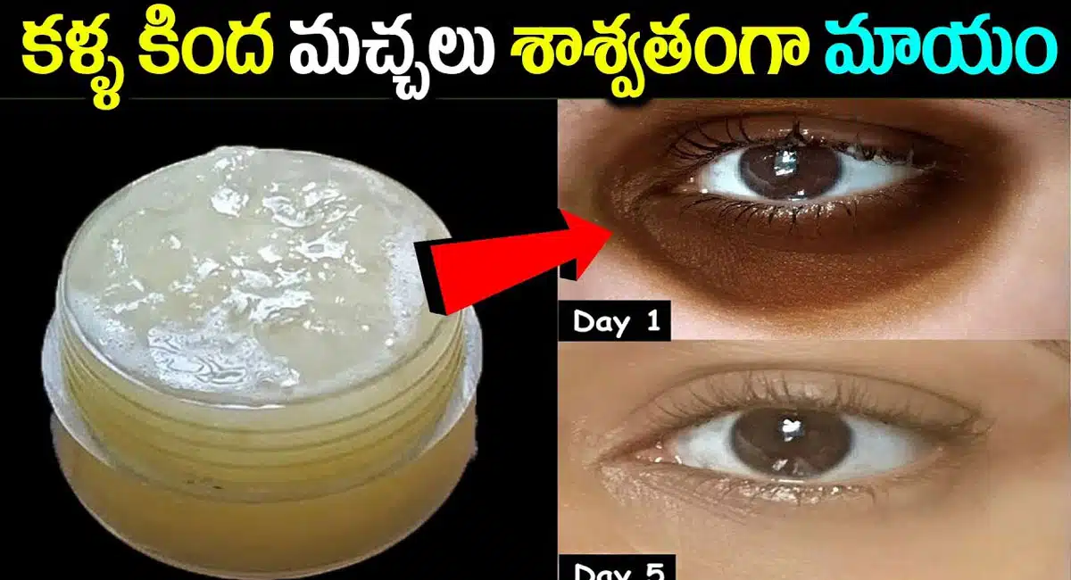 Removed Dark Circles in 5 Days with Potato Aloevera Eye Gel