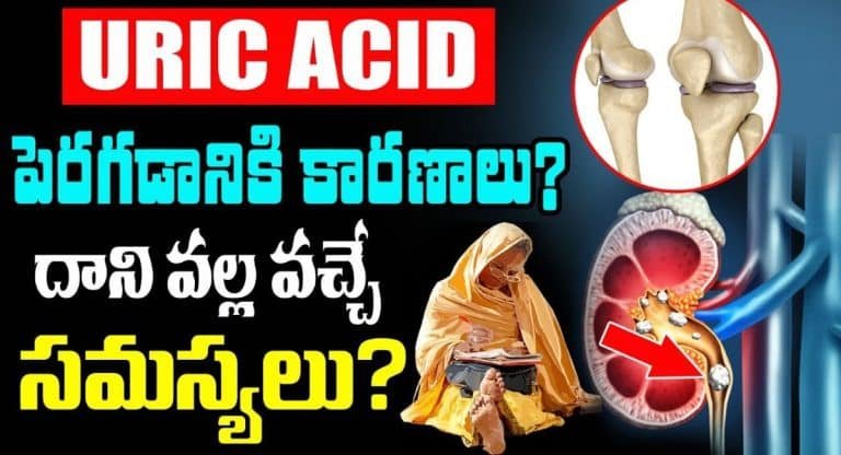 Uric Acid Tips : యూరిక్ యాసిడ్ పెరగడానికి అసలు కారణం ఇదే.. జాగ్రత్త పడండి…!!