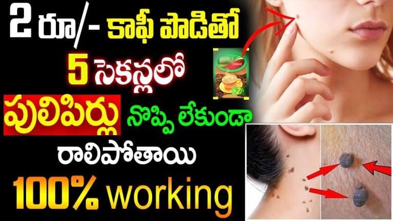 Wart Removal : కాఫీ పొడితో 5 సెకండ్ లో పులిపిర్లు నొప్పి లేకుండా రాలిపోతాయి…!!