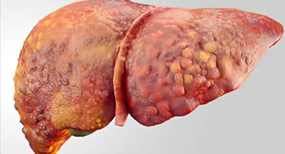 Why does fatty liver occur even in those who do not drink alcohol