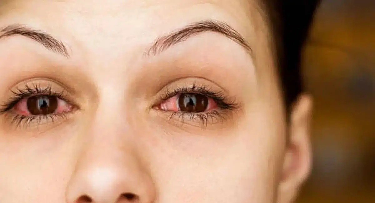 If your eyes are itchy and burning, do this for immediate relief