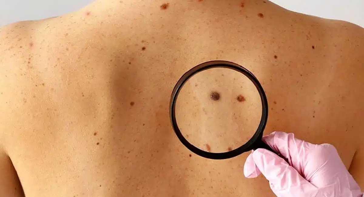 If you are seeing changes in your moles