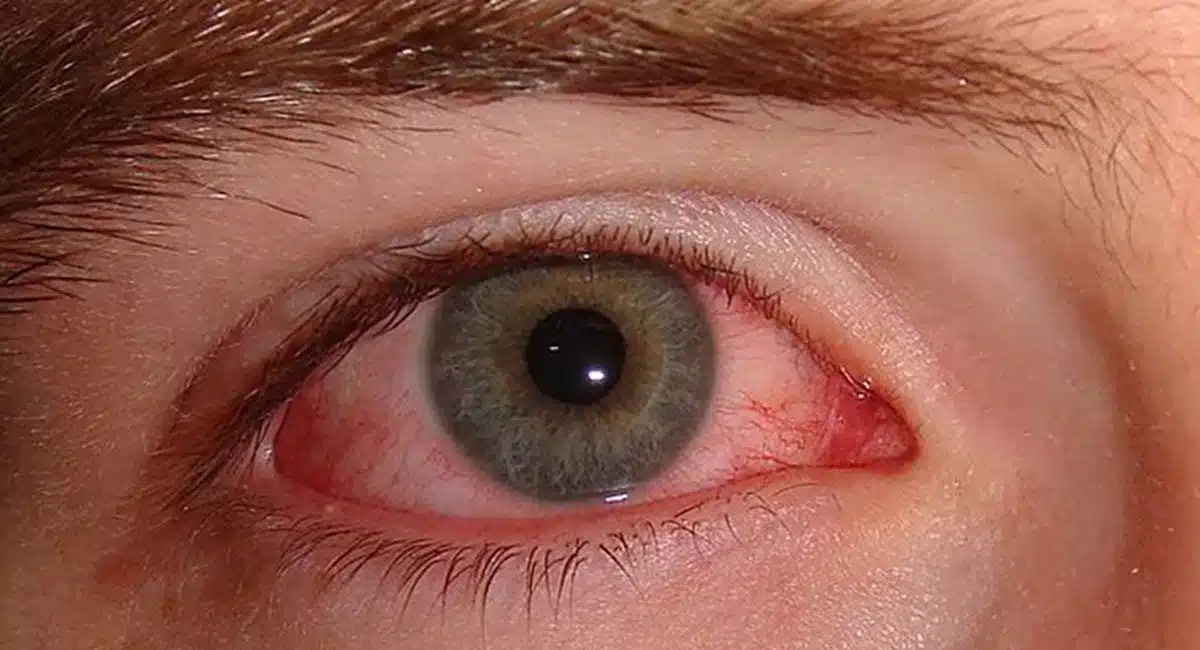 Eye conjunctivitis cases increasing