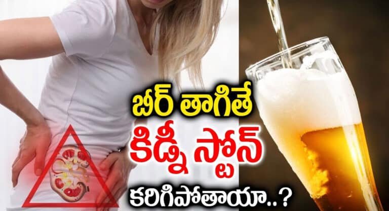 Beer : బీరు తాగితే కిడ్నీలో స్టోన్స్ కరిగిపోతాయా..?