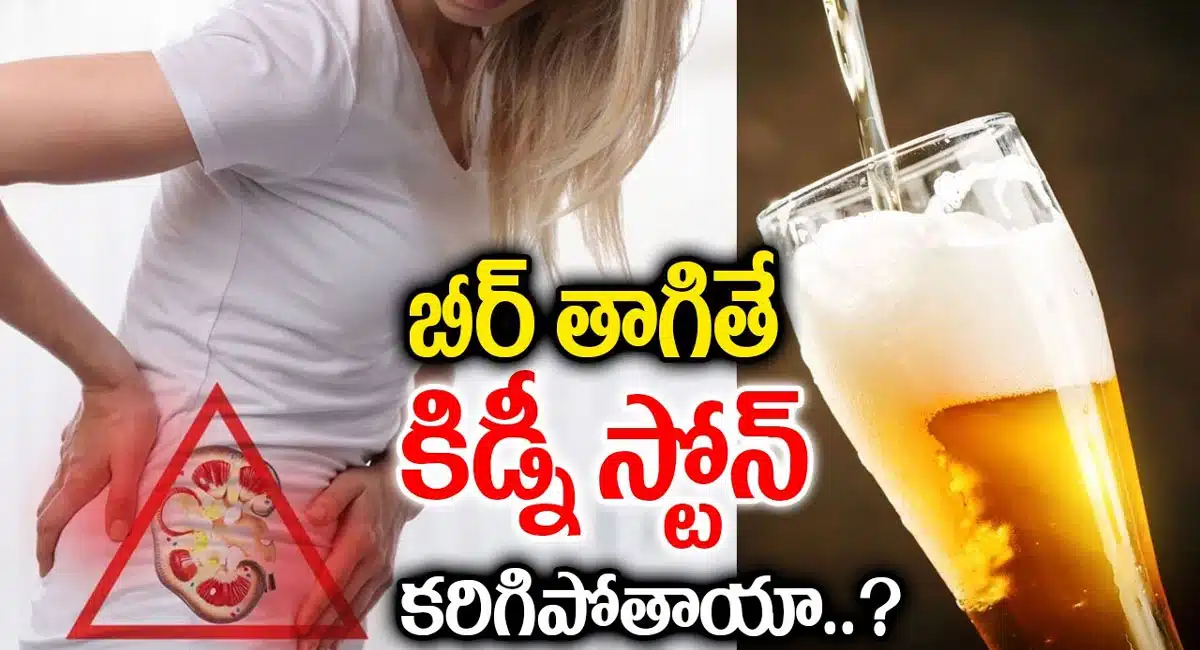 Does drinking beer dissolve kidney stones
