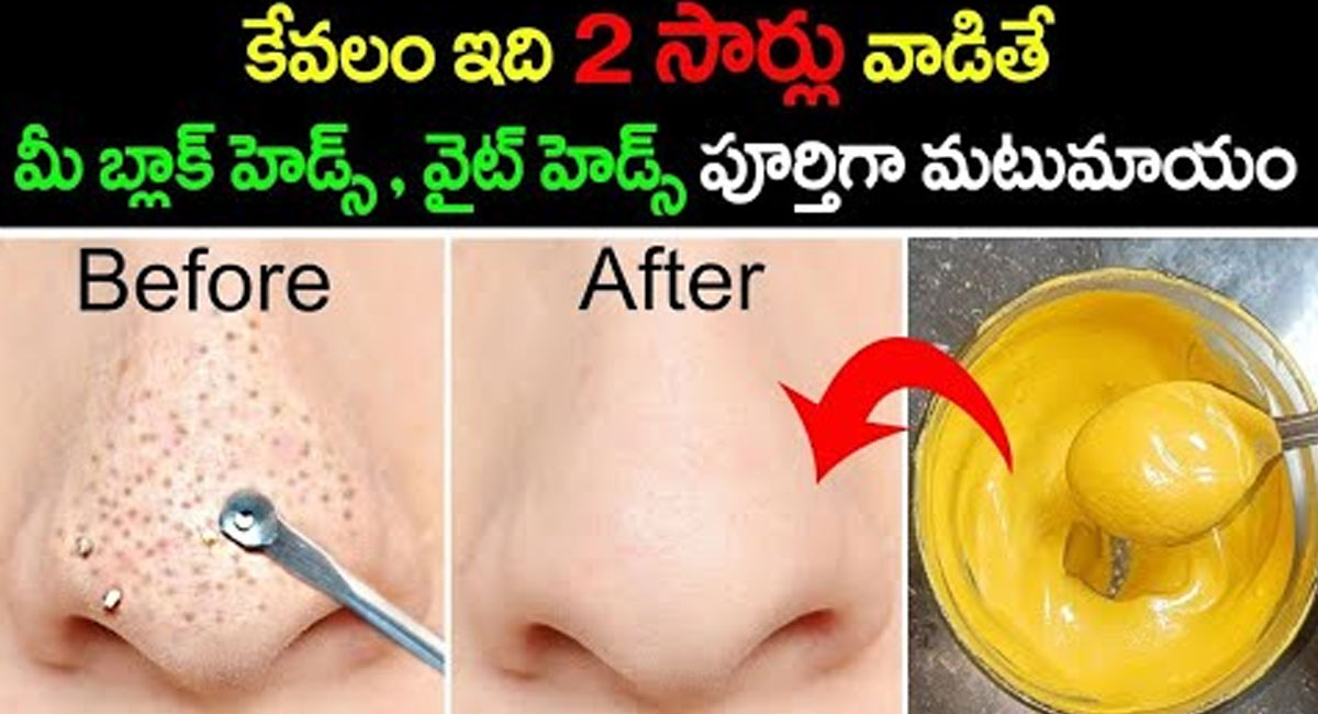 Blackheads : కేవలం 2సార్లు వాడితే చాలు.. మీ బ్లాక్ హెడ్స్ వైట్ హెడ్స్ పూర్తిగా మటుమాయం…!