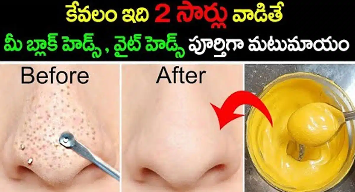 blackheads and whiteheads will disappear completely