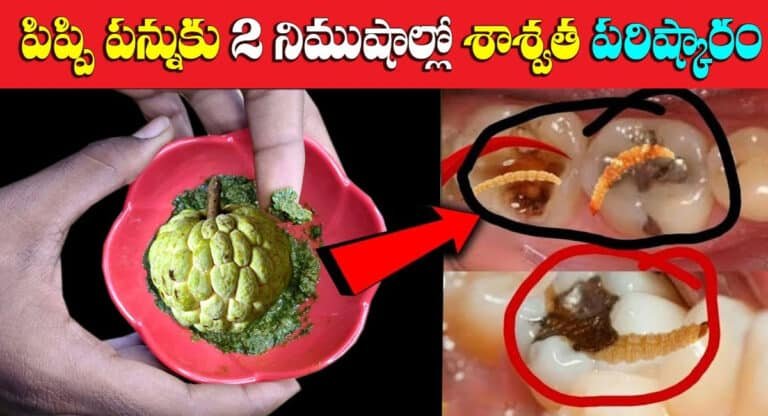 Teeth : పిప్పి పన్ను కు 2నిమిషాల్లో శాశ్వత పరిష్కారం…!