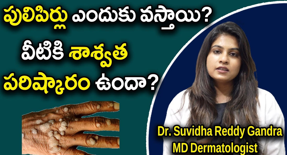 Pimples Occur : పులిపిర్లు ఎందుకు వస్తాయి..? వీటికి శాశ్వత పరిష్కారం ఉందా..!