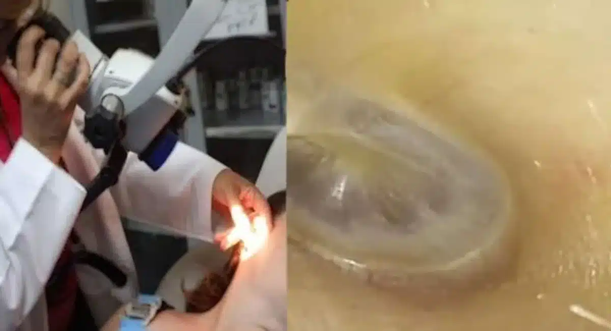 spider-in-ear-viral-video