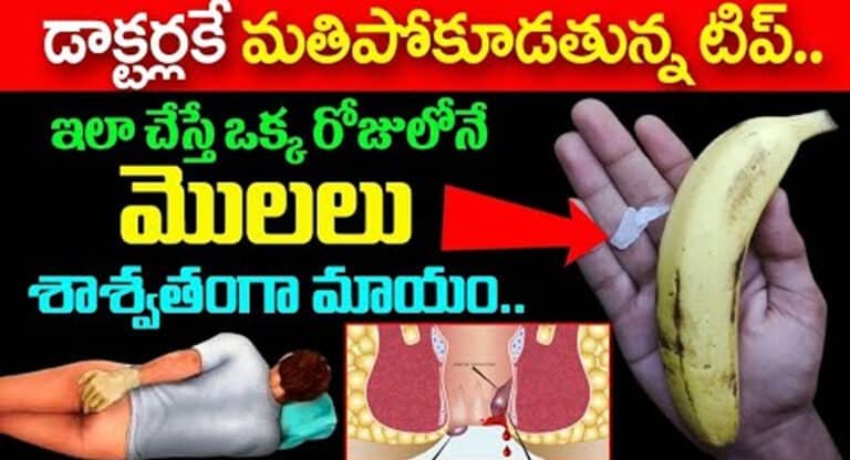 piles : డాక్టర్లకే మతి పోగోడుతున్న టిప్.. ఇలా చేస్తే ఒక్క రోజులోనే మొలలు శాశ్వతంగా మాయం…!
