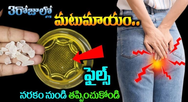 Piles : ఎంతటి భయంకరమైన ఫైల్స్ అయినా 3 రోజులలో మటుమాయం…!