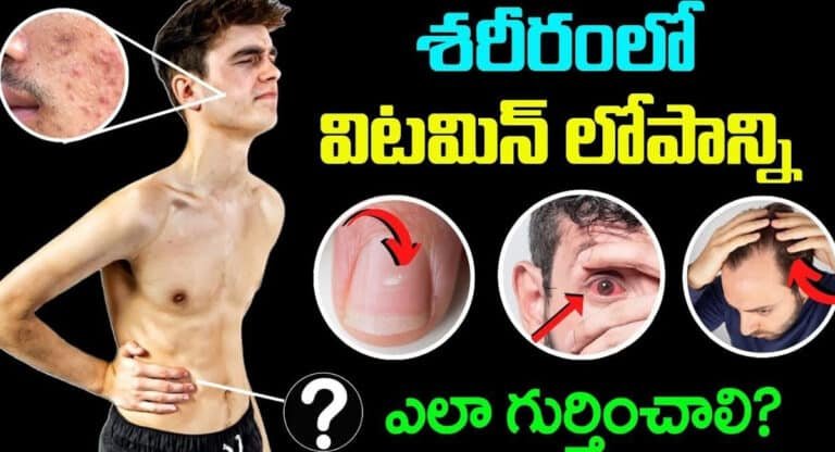 Vitamin : శరీరంలో విటమిన్ లోపాన్ని తెలిపే సంకేతాలు ఇవే…!!