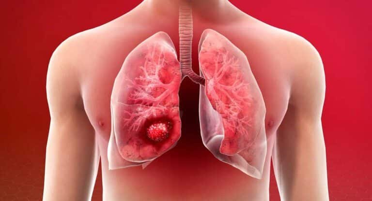 Lungs : ఇలా చేశారంటే మీ ఊపిరితిత్తుల సమస్యకు చెక్ పెట్టవచ్చు…!