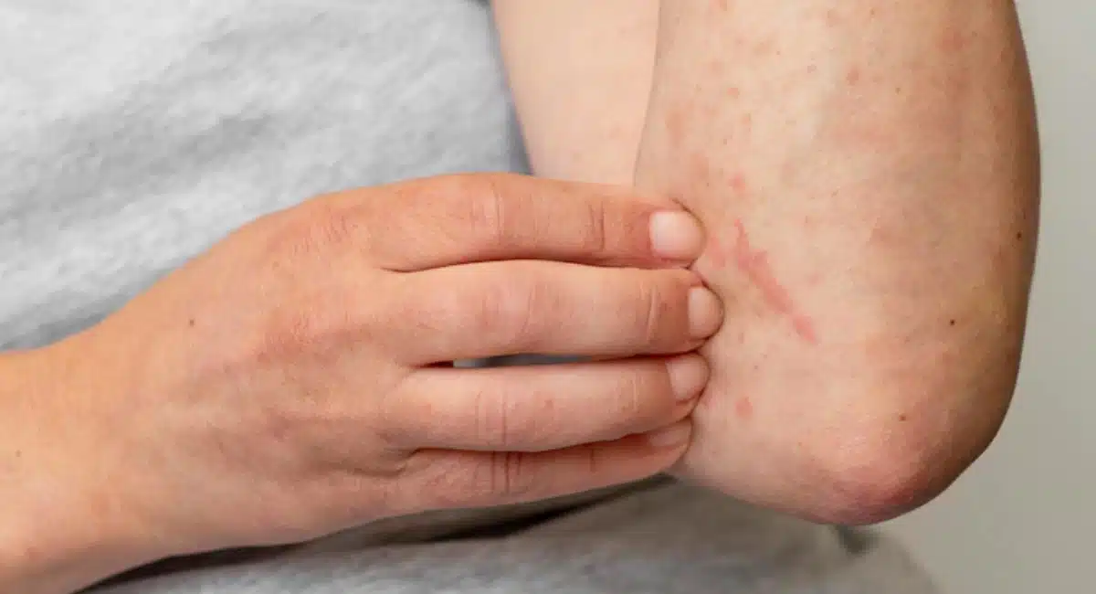 Skin Allergy : మీరు స్కిన్ ఎలర్జీతో బాధపడుతున్నారా..? అయితే ఇలా చేసి దానికి చెక్ పెట్టండి...!