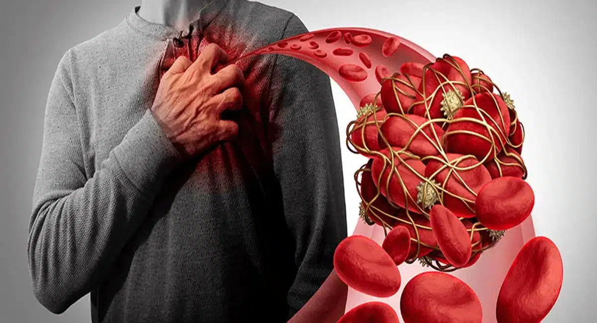 Blood Clotting : శరీరంలో రక్తం ఎందుకు గడ్డ కడుతుంది...? కారణాలు ఇవేనా..? జాగ్రత్తలు తీసుకోకపోతే..?