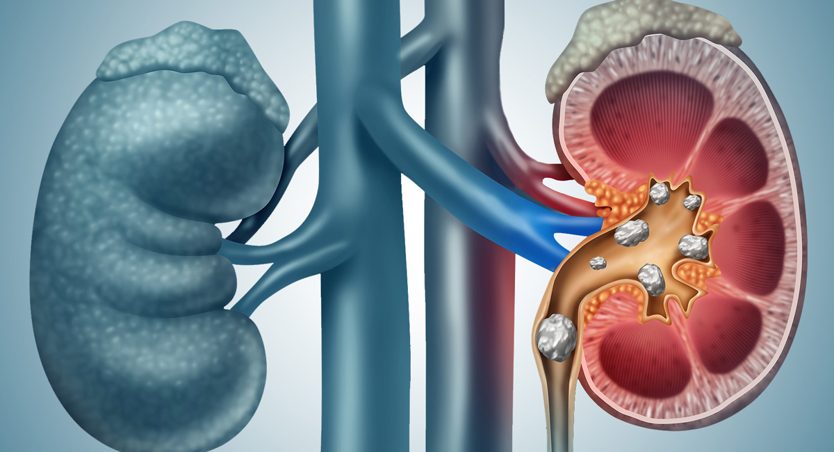 Kidney Stones : కిడ్నీలో రాళ్లు ఏర్పరిచే ఆహారాలు ఇవే.. వీటికి దూరంగా ఉండండి..!