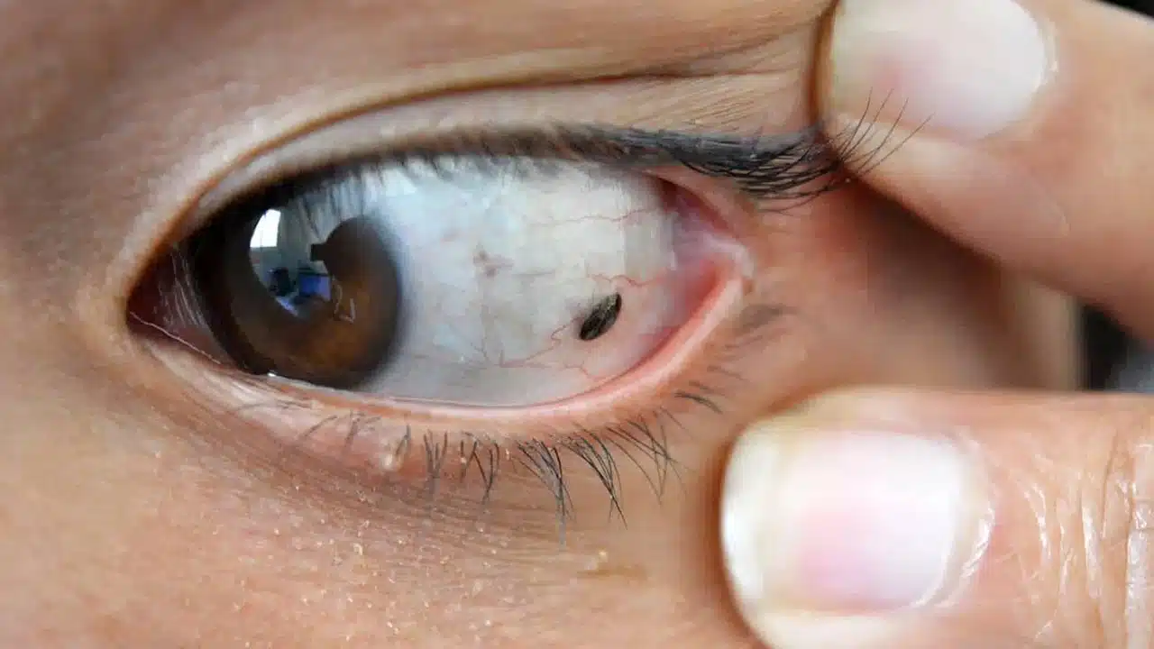 Eye Cancer : మీ కన్ను ఇలా మారితే దానికి సంకేతమే... వెంటనే అప్రమత్తం అవ్వండి...!