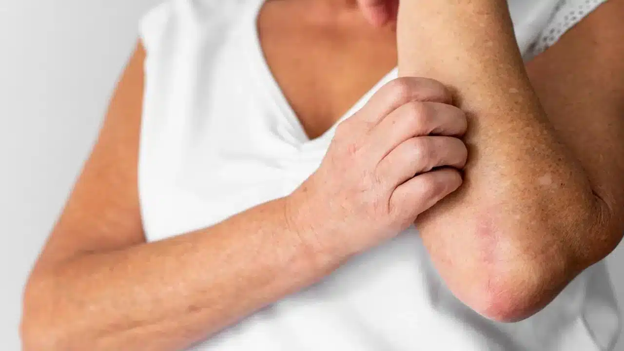 Diabetes : డయాబెటిస్‌ వ్యాధిగ్రస్తులకు చర్మంపై దద్దుర్లు ఎందుకు వస్తాయి.. ఎలా రక్షించుకోవాలంటే...?