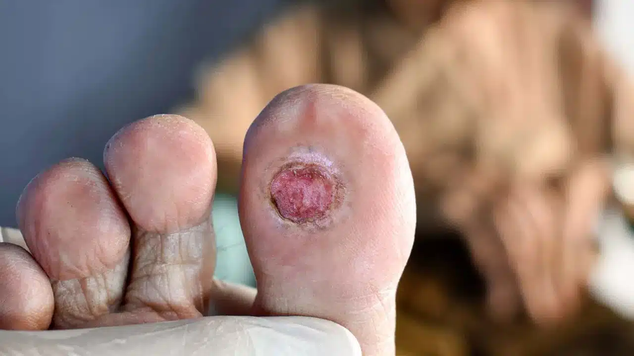 Diabetes : డయాబెటిస్ పేషెంట్లకు ఈ సింటమ్స్ కనిపిస్తే... ప్రమాదం లో పడ్డట్టే... ఏ మాత్రం అశ్రద్ధ చేయకండి...!