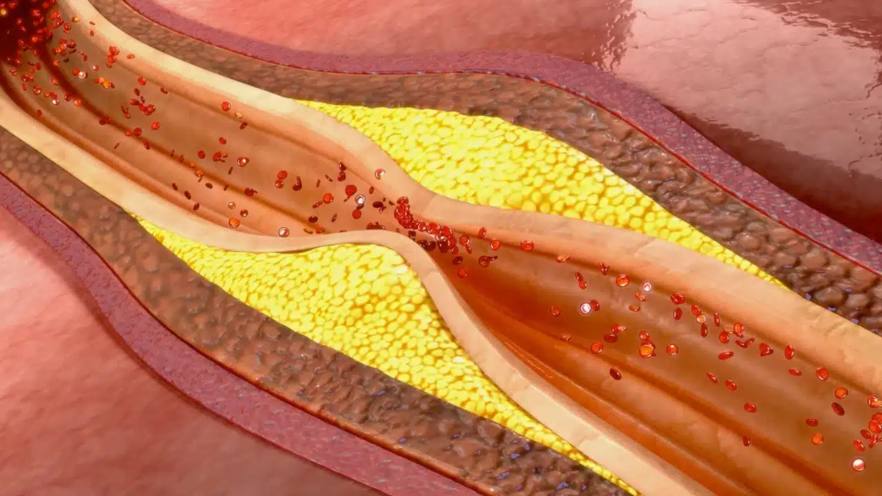High Cholesterol : మహిళల్లో అధికంగా పెరుగుతున్న కొలెస్ట్రాల్... కొత్త లక్షణాలివే...!