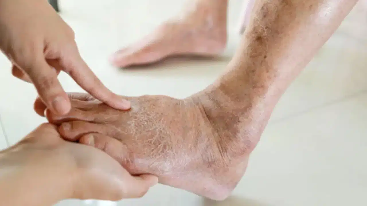 Diabetic Patients : డయాబెటిస్ రోగుల్లో ఈ లక్షణాలు కనిపిస్తే... వెంటనే వైద్యులను సంప్రదించండి...!