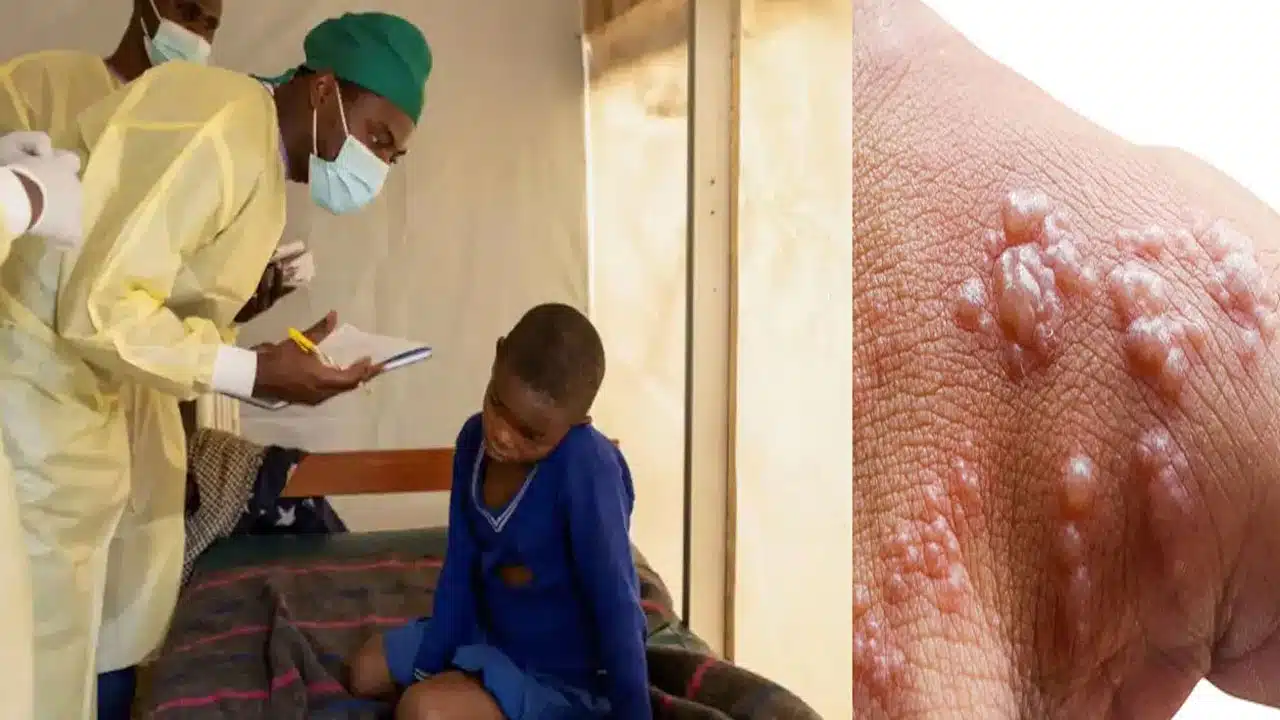 Monkey Pox Virus : మంకీ పాక్స్ వైరస్ తో మానవాళికి మళ్లీ ప్రమాదమా... దీనికి నివారణ ఏంటి...!