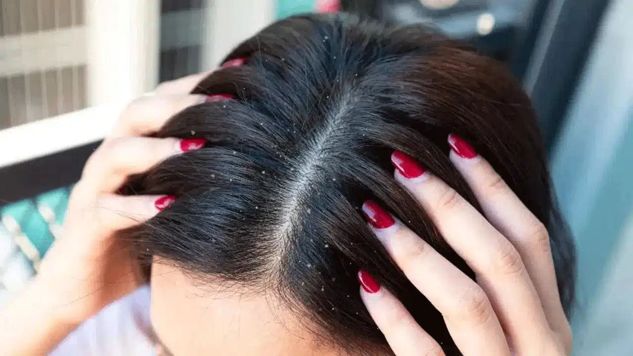 Dandruff : ఈ రెండిటితో చుండ్రు సమస్యలను ఈజీగా తొలగించవచ్చు... ఎలాగంటే..?