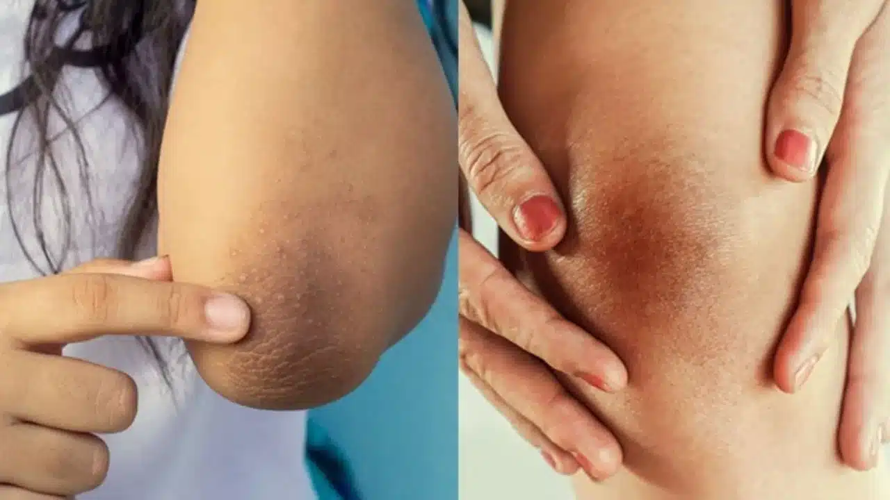 Skin Care : ఈ టిప్స్ పాటించండి ... మోచేతులు మరియు మోకాళ్లపై ఉండే నలుపుకు గుడ్ బై చెప్పండి...??