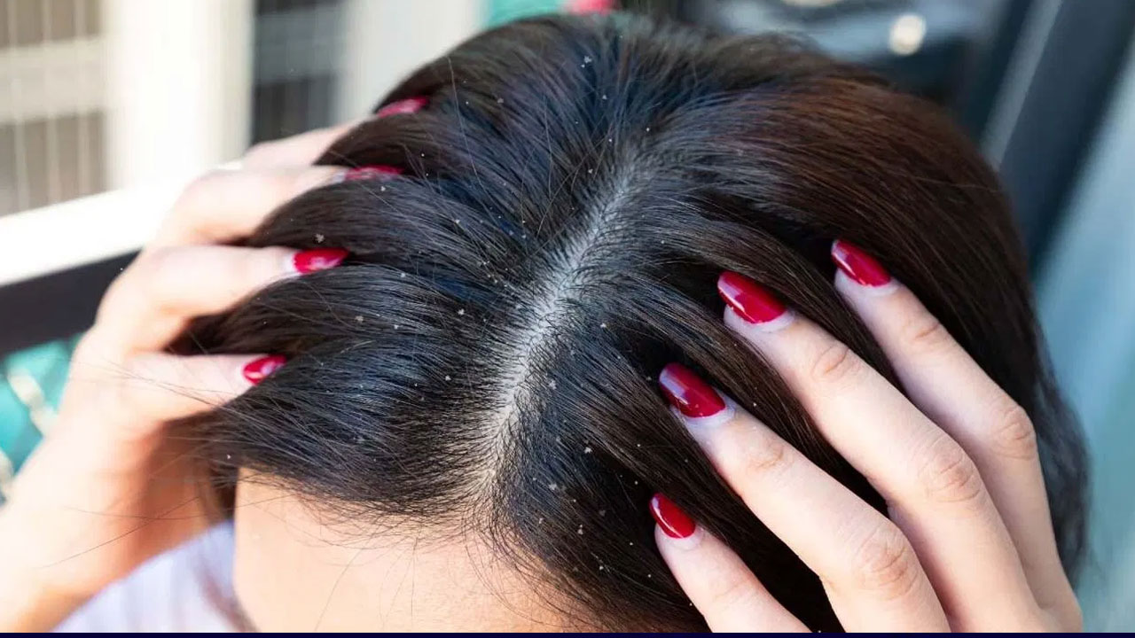 Dandruff : తలలో చుండ్ర సమస్యతో ఇబ్బంది పడుతున్నారా… ఈ హోమ్ రెమిడీ పాటించండి…??