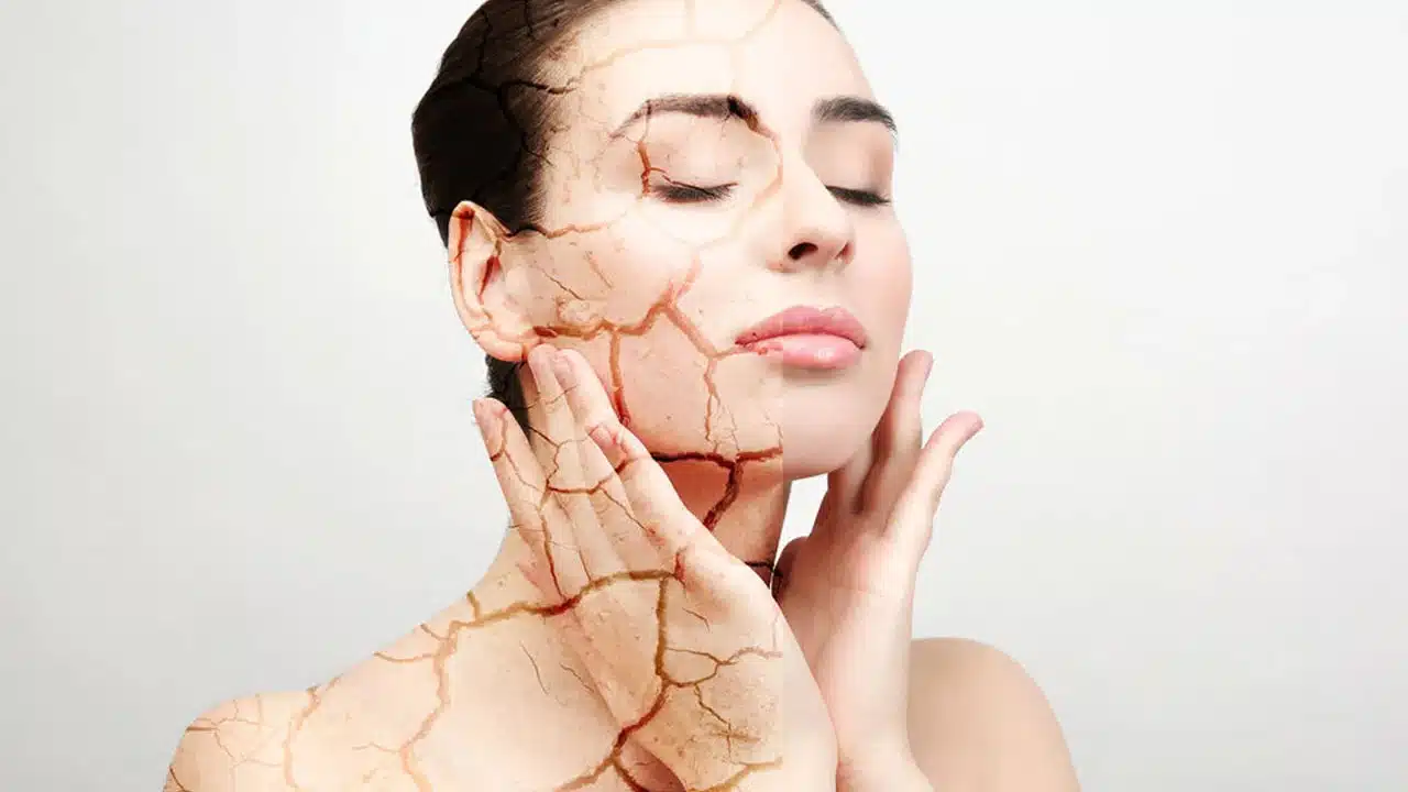 Skin Crack : చలికాలంలో చర్మం పగలటానికి అస్సలు కారణాలు ఇవే... అవేమిటో తెలుసా...??