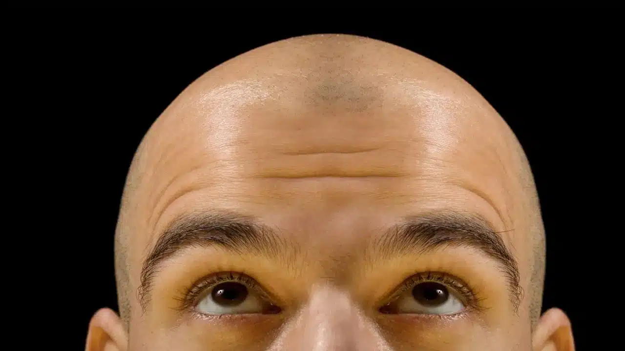 Bald Head : బట్టతల వస్తుందని చింతిస్తున్నారా... మరి బట్టతల రాకుండా ఉండాలంటే రోజు ఈ ఒక్క పనిని చేయండి....!