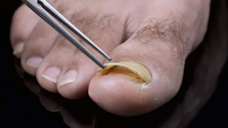 Toenails : కాలి గోర్ల రంగు మారితే వెంటనే అప్రమత్తం అవ్వండి… లేకుంటే డేంజర్ లో పండట్టే…??