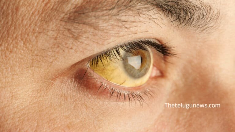 Eyes : మీ కళ్ళు పసుపు రంగులో కి మారుతున్నాయా… అయితే..4 డేంజర్ వ్యాధులకు సంకేతం…?