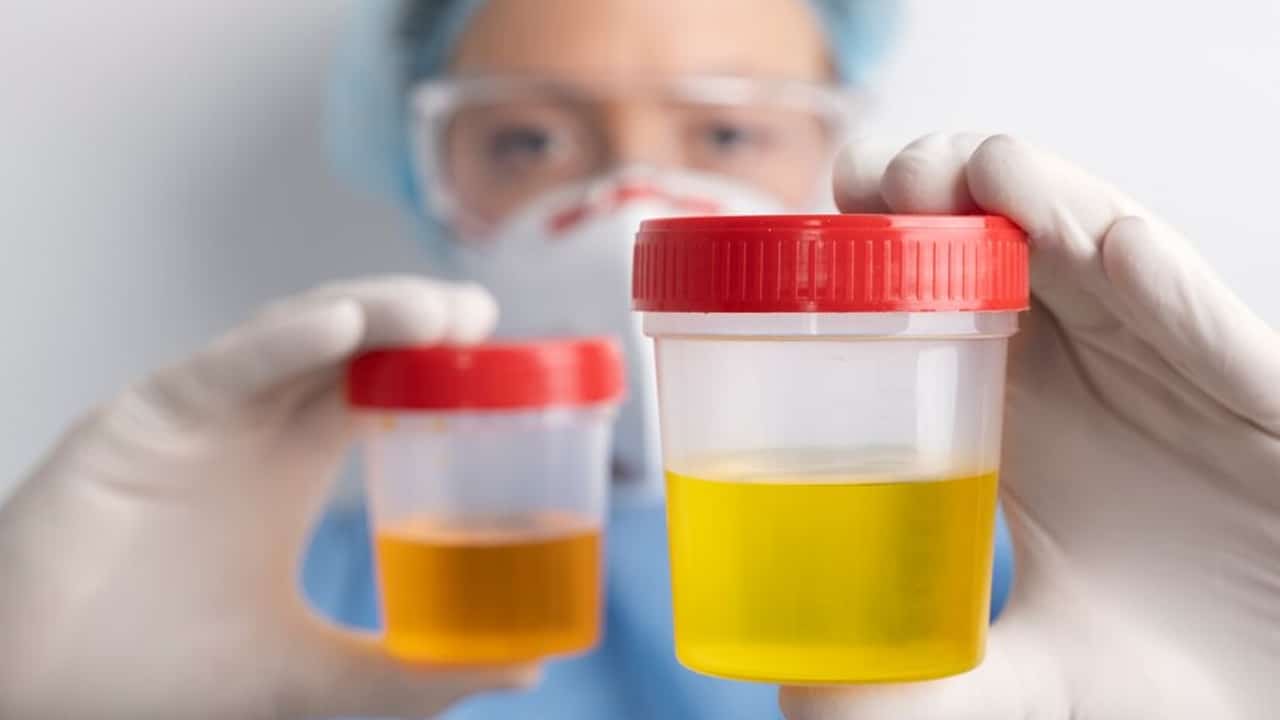 Urine Colours Alert మీ యూరిన్ రంగు కిడ్నీల ఆరోగ్యాన్ని తెలియజేస్తుంది ఈ రంగులో ఉంటే కిడ్నీలు ప్రమాదంలో ఉన్నట్లే